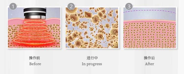 Unoisetion cavitation