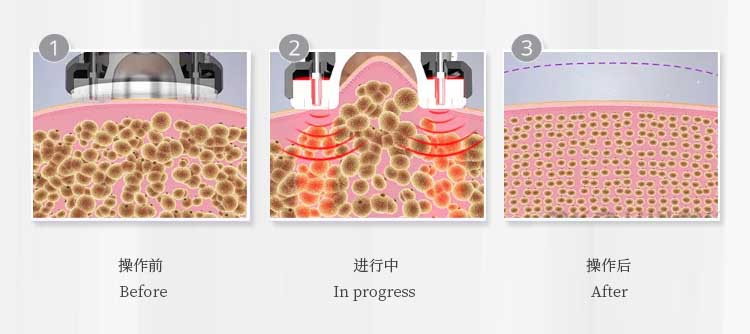 lipolaser pads machine