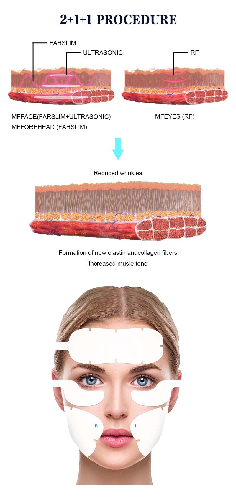 Face Lifting Face Sculpt